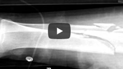 LAA Emma leg x-ray
