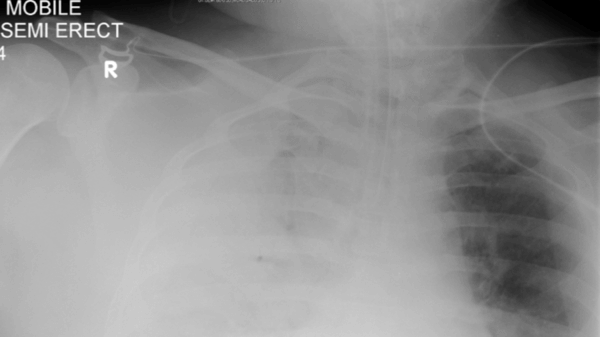 patient x ray hypoxia