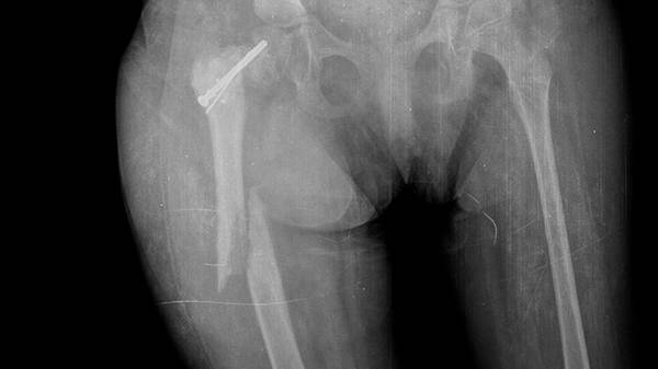 X-ray