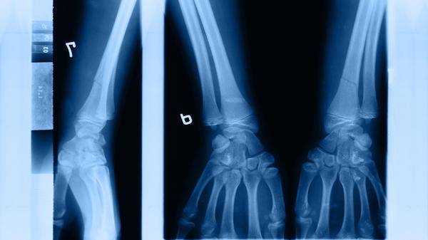 Fracture x-ray